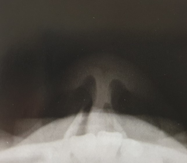 nasal bone tangential projection : 네이버 블로그