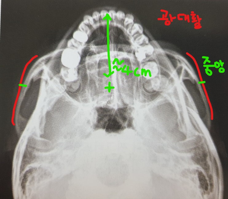 submentovertical zygomatic arches