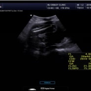 임신 25주 : 임당검사 / 임당재검