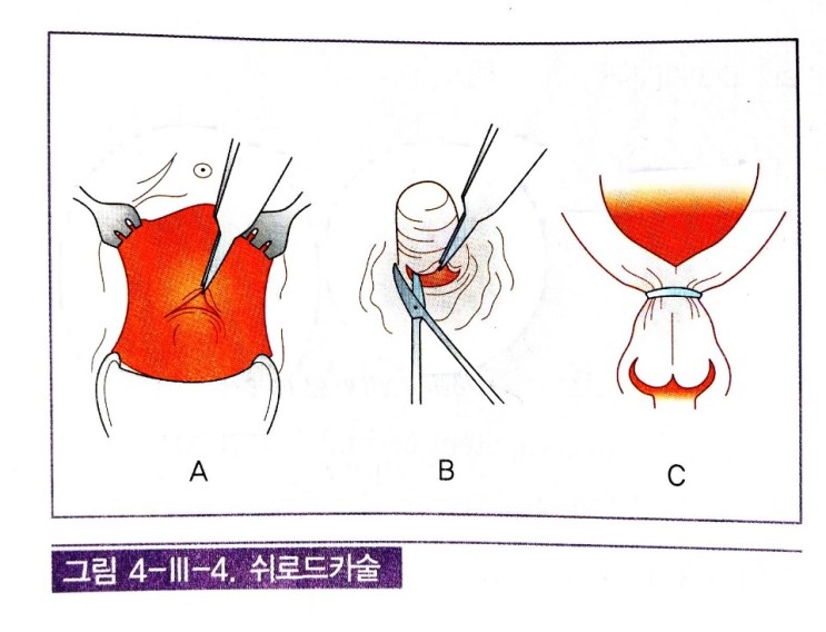 [모성간호학2]자궁경관무력증(incompetent cervix) : 네이버 블로그