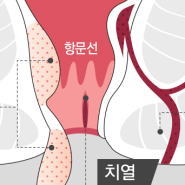 치질약 추천 셀프 완치후기 (병원안감)