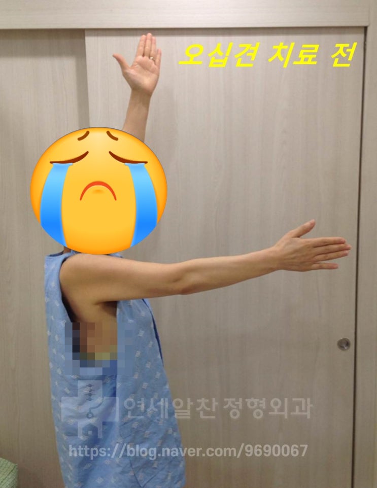 오십견치료 정답이 있다면?