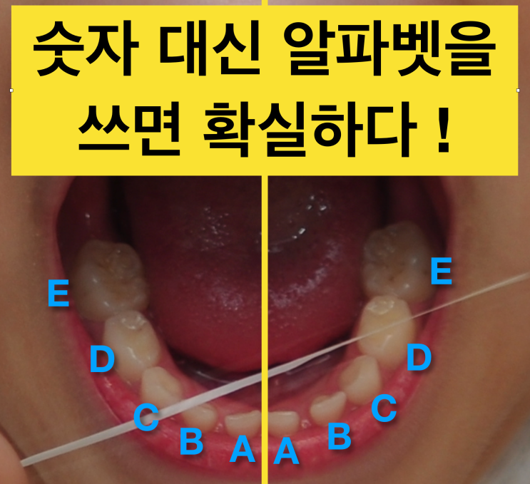 유치갯수, 유치 치아번호를 알아보자 (치과의료사고 예방, 영구치와 유치 혼동 주의 !) : 네이버 블로그