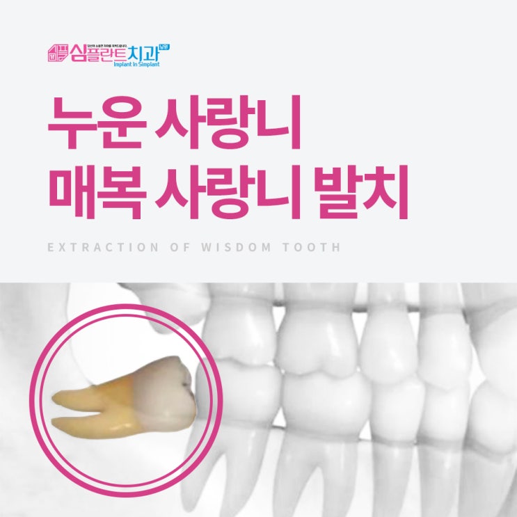 남원치과, 사랑니 발치 미루지 마세요!!! : 네이버 블로그