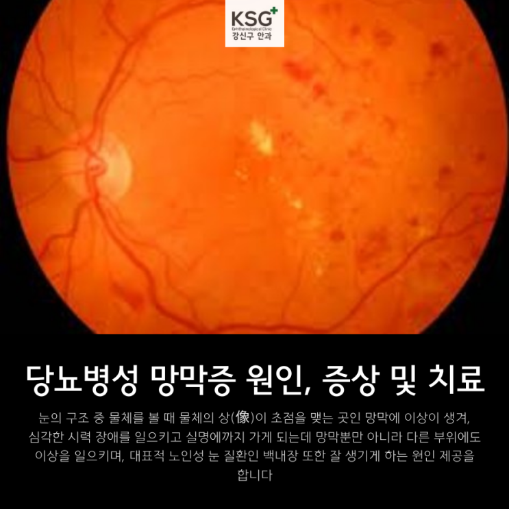 당뇨병성 망막증 원인, 증상 및 치료 : 네이버 블로그