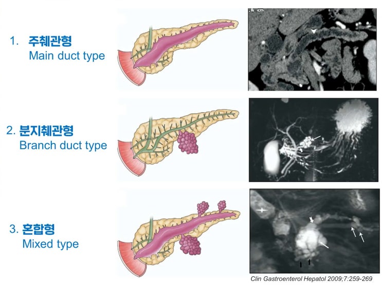 [간·담도·췌장센터] 췌장(Pancreas)질환의 진단과 치료: 췌장염, 췌장물혹, 췌장암 : 네이버 블로그
