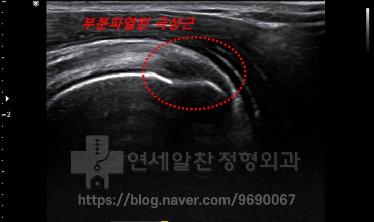 어깨회전근개파열 어떻게 치료해야할까?