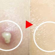 엉덩이 종기 원인 [고약 vs 나코크림] 엉덩이 색소침착+치료법