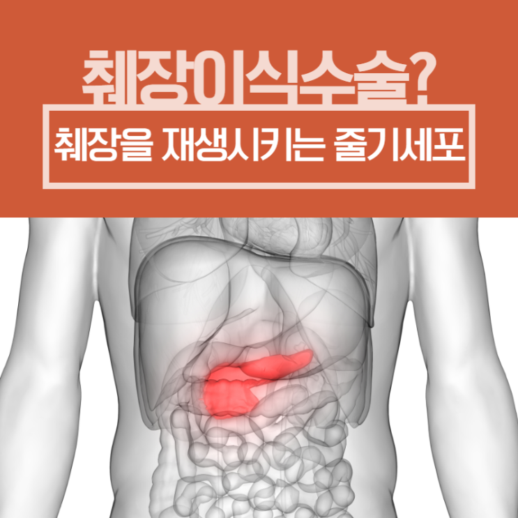 당뇨 췌장이식 없이 췌장을 재생시키는 줄기세포 : 네이버 블로그