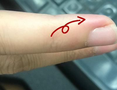 손톱거스러미 뜯다 생인손 염증생겼을 때, 집에서 치료하는 방법 : 네이버 블로그