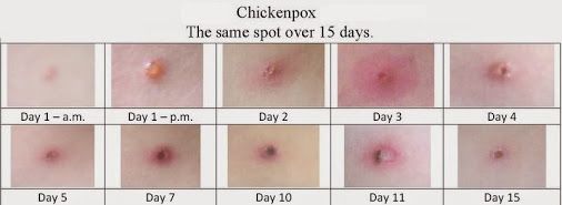 the-chickenpox-virus-has-a-fascinating-evolutionary-history-that