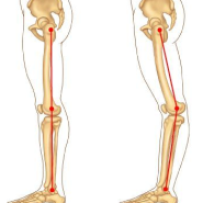 [ 반장슬(Back Knee)/젖힌 무릎(genu recurvatum) ] 지미필라테스 / 불광동필라테스 / 불광역필라테스 / 녹번동필라테스