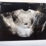 임신초기증상/감기몸살/입덧 임신하면 나타나는증상들(1~14주)