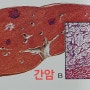 암환자는 암이 무서운 것이 아니라 죽음이라는 공포의 생각이 암 치유를 어렵게 한다. 암예방12가지와 와송의 효능