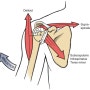 견관절 충돌증후군 - 2편 회전근개