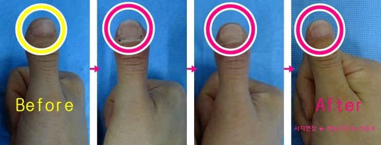 단지증 손가락 타입 D 수술후 회복과정 : 네이버 블로그
