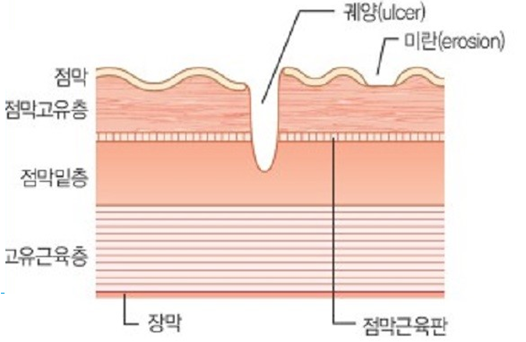 위염(gastritis)과 위궤양(gastric ulcer, peptic ulcer) : 네이버 블로그