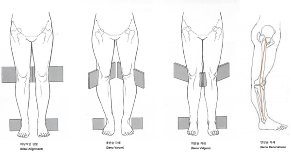 Low limb Alignment : 네이버 블로그