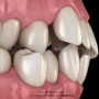 삐뚤한 치아로 인해 생기는 문제점으로는 어떤 것들이 있을까요?