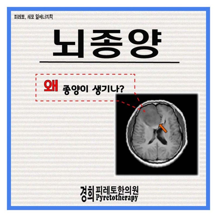 뇌종양 - 종기, 종양, 암종의 발생 원인 심층 분석 : 네이버 블로그