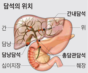 담석(Gallstone) : 네이버 블로그