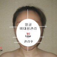 [강남대치동] 얼굴작아지는법 얼굴 균형관리로 젊어진 모습 찾기