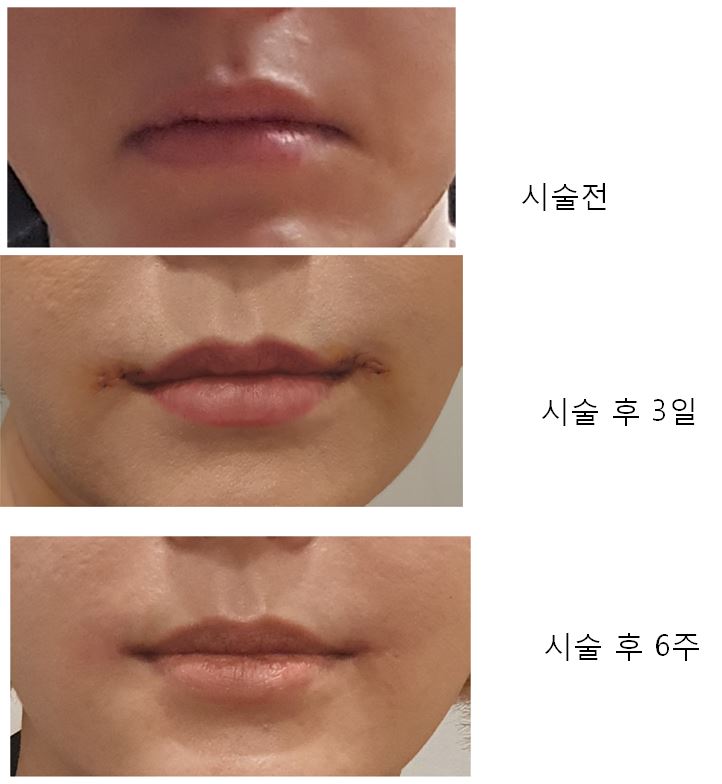 입꼬리 수술 경과 : 네이버 블로그