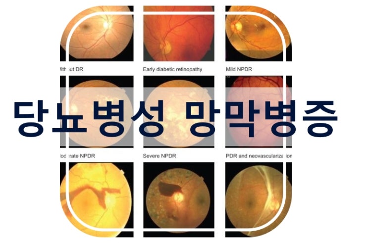 당뇨합병증 눈에도 와요! 당뇨성 망막 질병인 당뇨병성 망막병증 증상과 치료관리 방법은? : 네이버 블로그