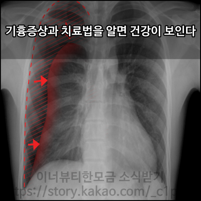 기흉치료방법, 기흉증상을 알면 건강이 보인다. : 네이버 블로그