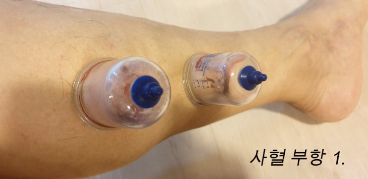 자연정혈요법- 하지정맥류치료 사혈요법 : 네이버 블로그