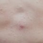 다발성 피지 낭종(Steatocytoma multiplex)/범계 안양 피부과