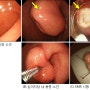 부르너샘 과형성과 부루너샘 과오종