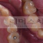 교정치료 종료 후 유지장치