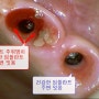 엑스레이로 임플란트 상태 보는 법