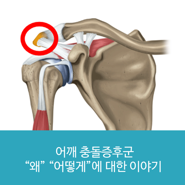 분당 어깨치료잘하는병원 전문의가 밝히는 어깨충돌증후군 정체 : 네이버 블로그