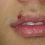 입술 단순포진 원인, 증상, 치료 등 - 피부과 전문의 정성규