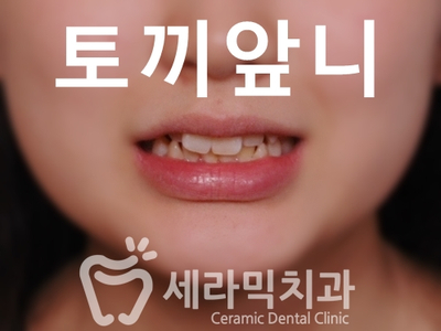 토끼 이빨