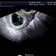 임신7주 : 심장소리 / 임신단축근무
