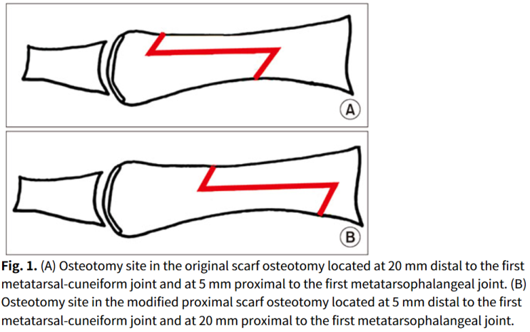 Modified Proximal Scarf Osteotomy for Hallux Valgus : 네이버 블로그