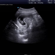임신9주 : 젤리곰 / 산전검사