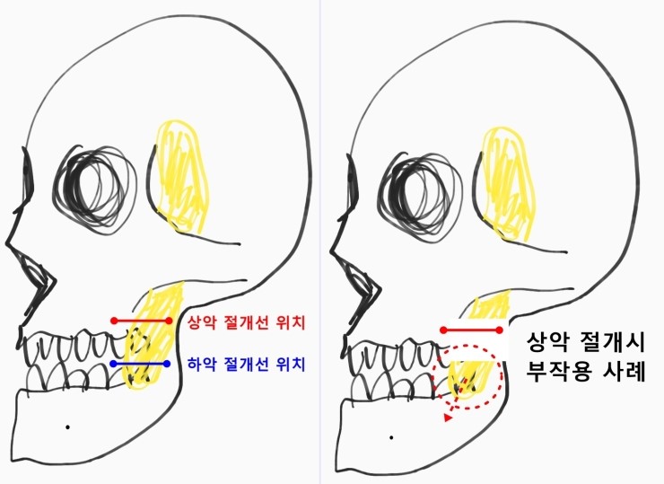 심부볼지방제거 리얼후기 (2021년 업데이트 추가) : 네이버 블로그