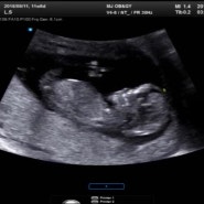 임신12주 : 1차 기형아검사 / 각도법