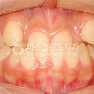대연동치아교정 반대교합
