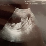 임신 13주 : 임신성 비염