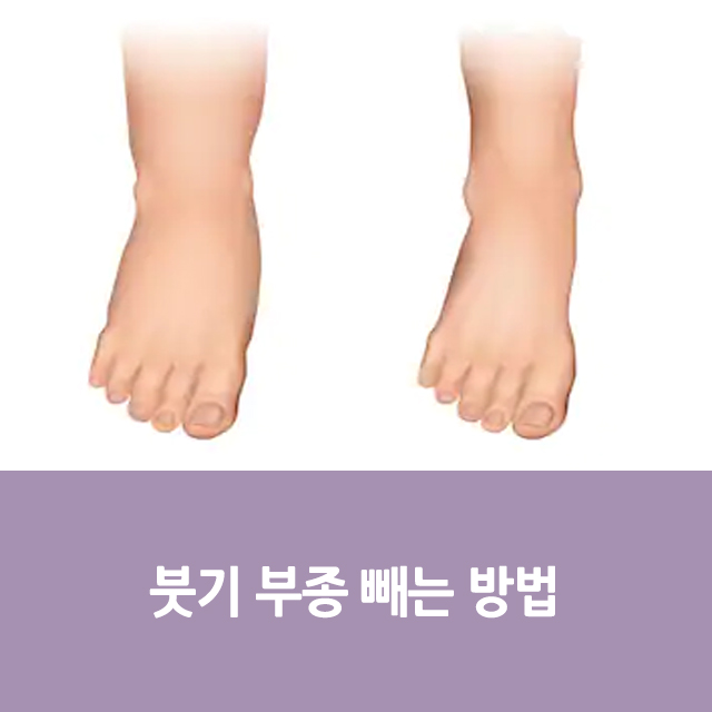 부기 부종 빼는 방법 : 네이버 블로그