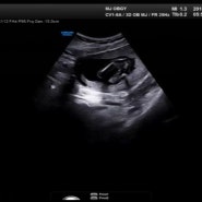 임신 16주 : 2차 기형아 검사 / 각도법 후기
