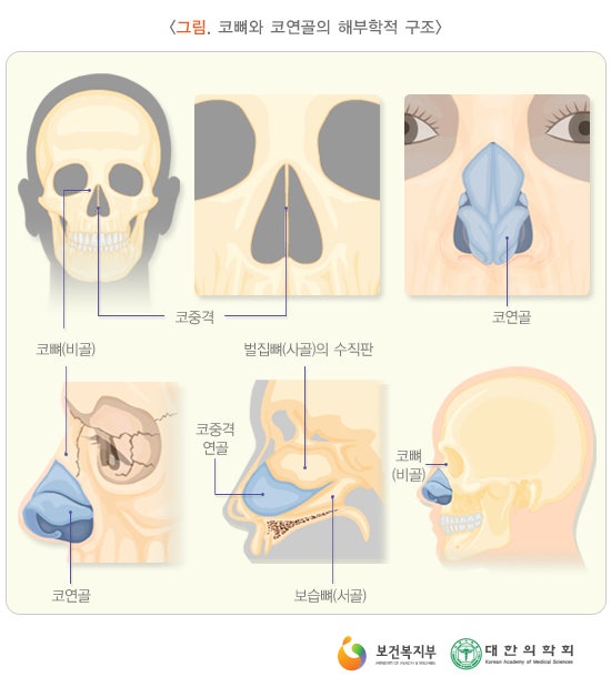 코뼈 골절 증상과 치료방법 : 네이버 블로그