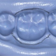 [치아의 기본 형태] 자연치 형태의 관찰로 시작하는 수복치료