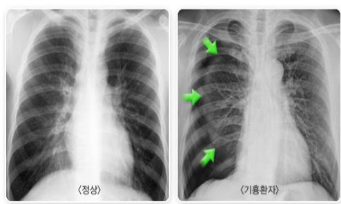 [흉부외과] 기흉의 원인 / 예방 / 치료에 관한 내용 정리 : 네이버 블로그