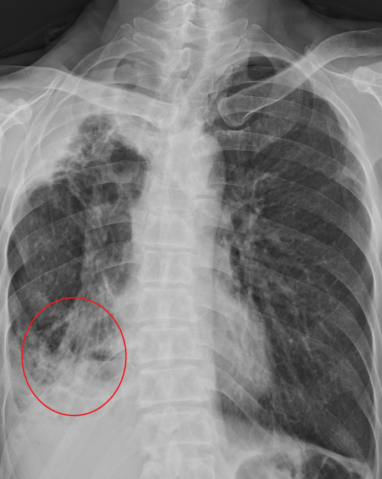 과거 폐결핵 투약력, x-ray상 결핵에 의한 파괴폐 있는 분, 3주간의 기침으로 내원, 증상은 감기후 상기도증후군, 판독은 ...